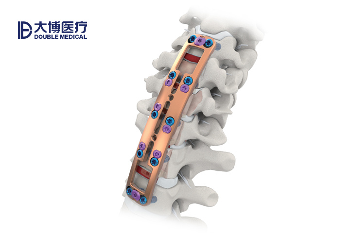ACAF頸椎前路釘板系統