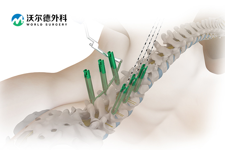 胸腰椎後路釘棒內固定系統(微創)