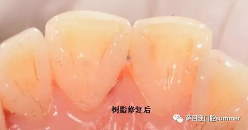 损情况和 使用材料情况，选用树脂修复、全瓷修复、烤瓷修复等。树脂修复 　　树脂修复是指因龋齿、楔状缺