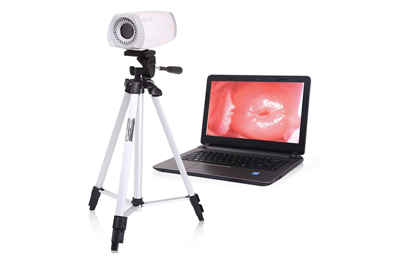 Portable Video Colposcope