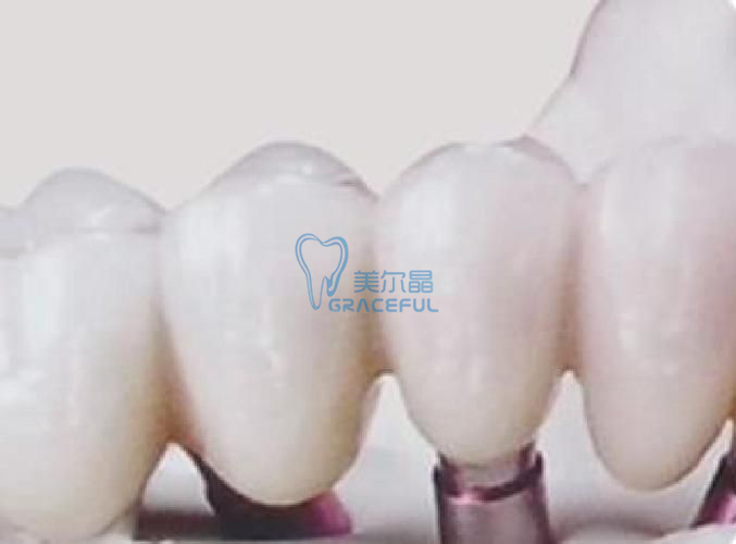 implant with crown