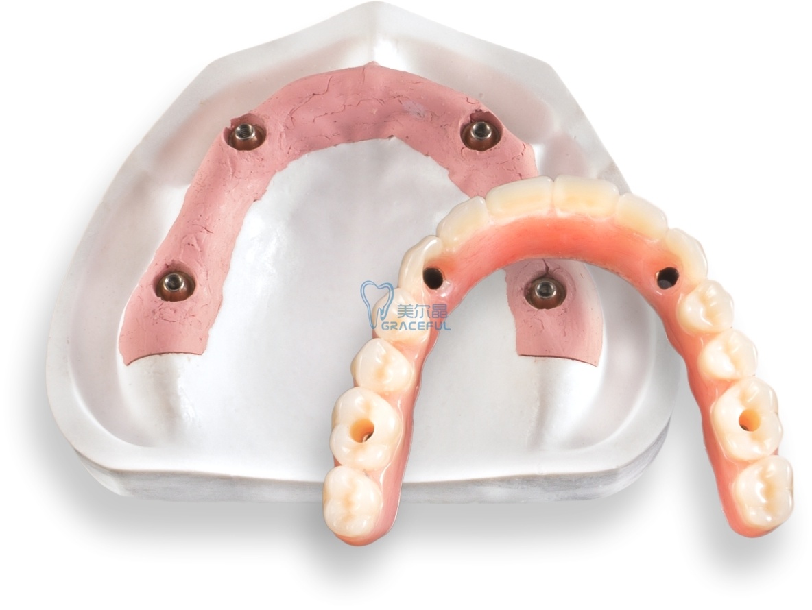 implant over denture