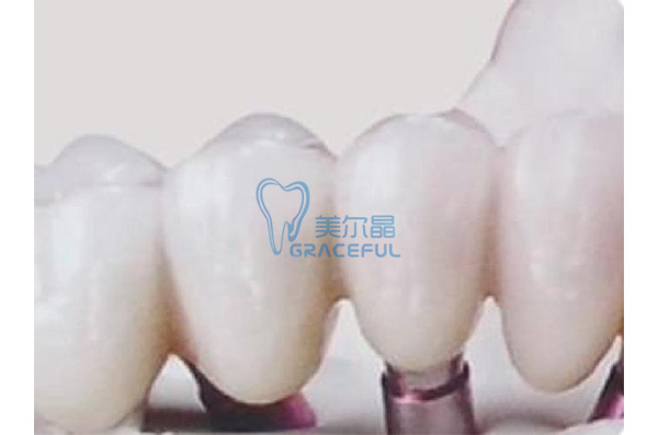 implant with crown