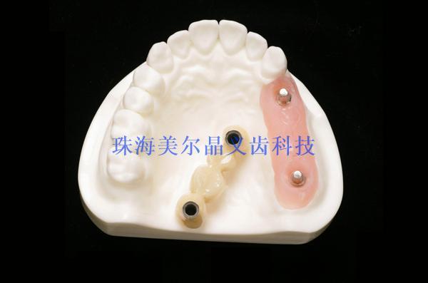 Dental implant