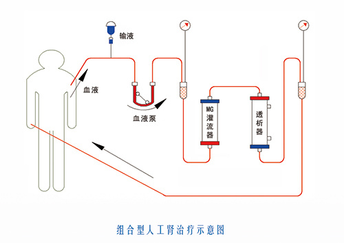 血液灌流器