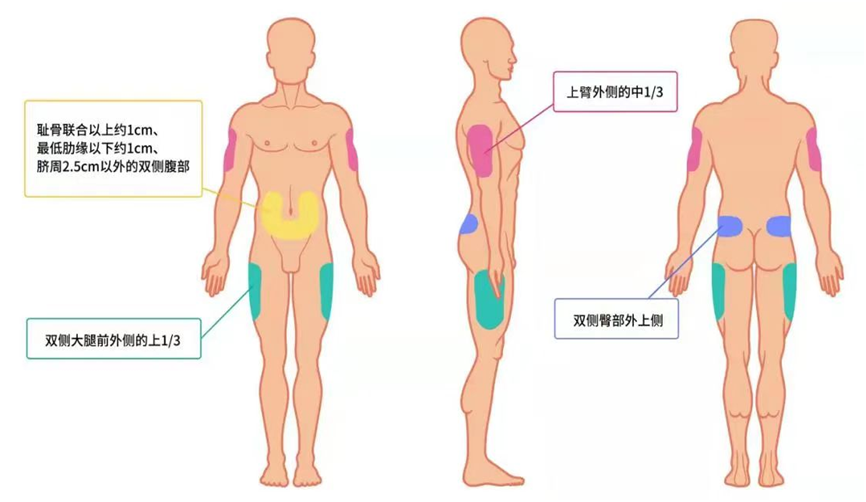 打胰岛素正确部位图图片