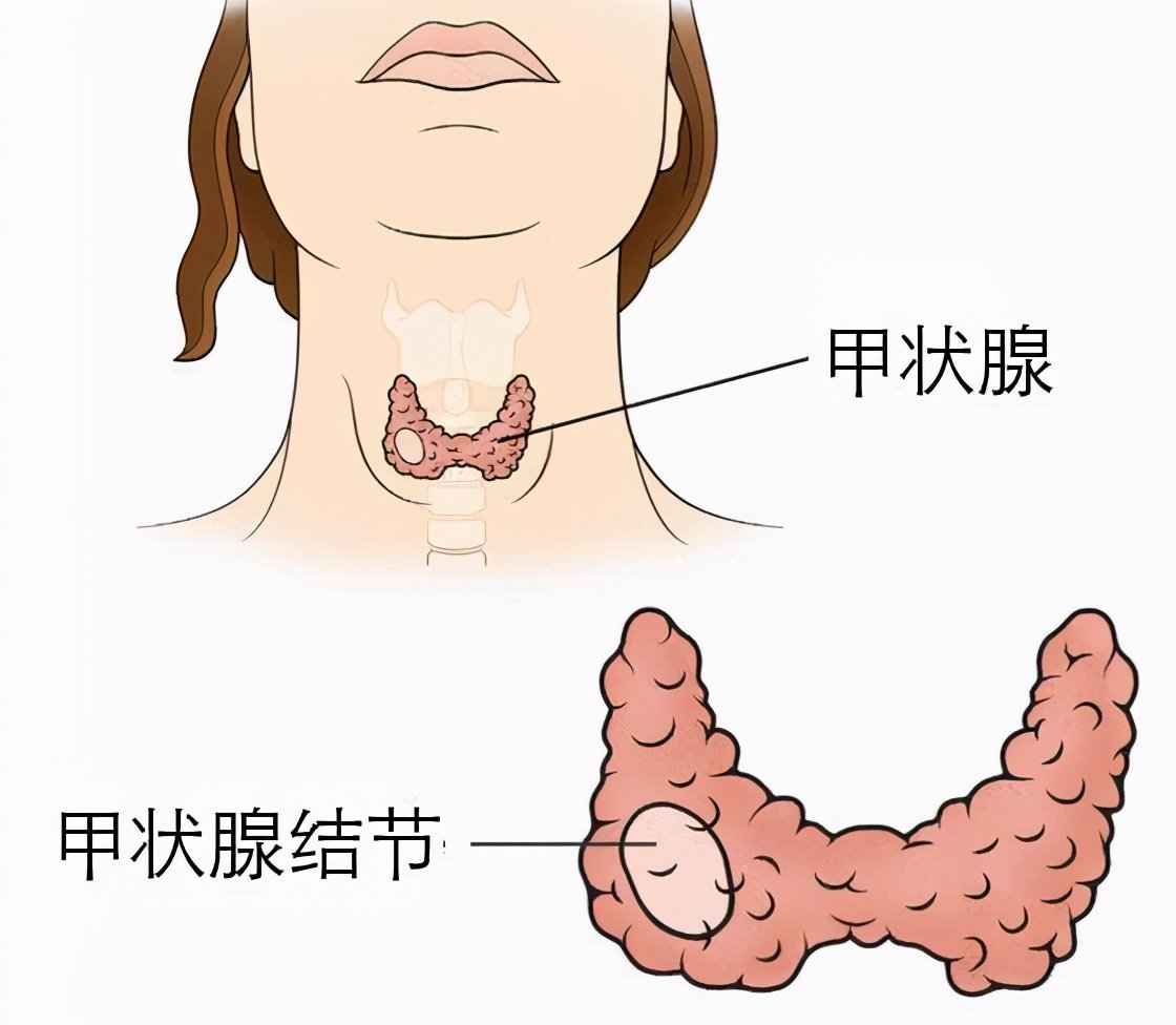 甲状腺人体图片