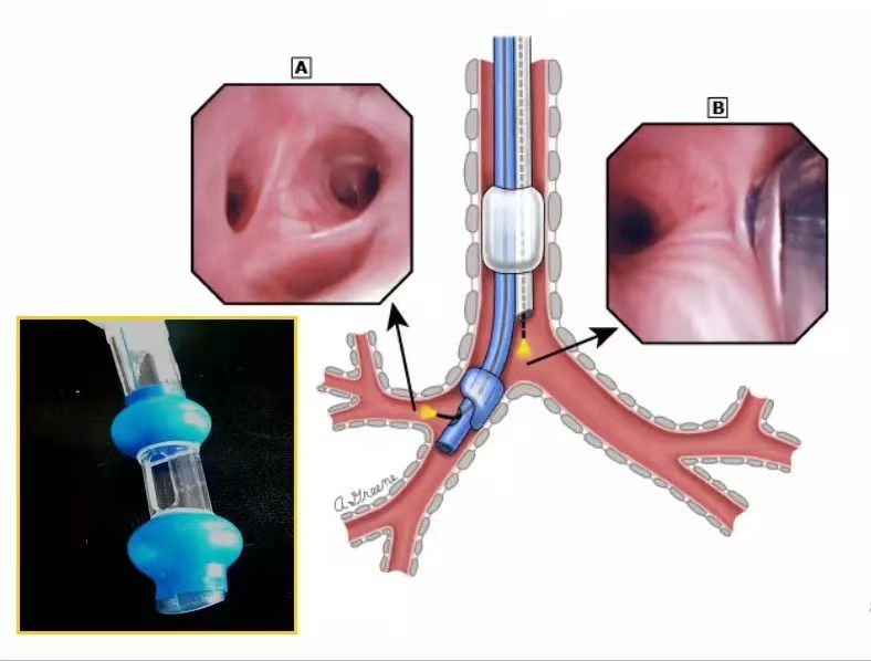 双腔气管导管图解图片