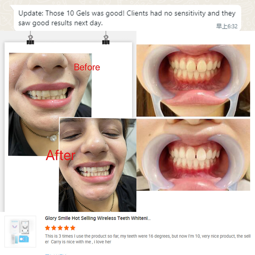 20220526 Glorysmile Teeth Whitening Feedback Update