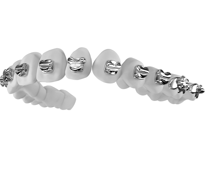 個性化唇側(cè)矯治系統(tǒng) 個性化唇側(cè)矯治系統(tǒng)