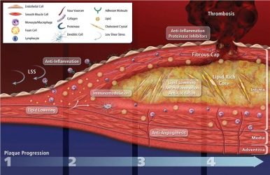 心血管疾病模型Cardiovascular 動(dòng)脈粥樣硬化模型