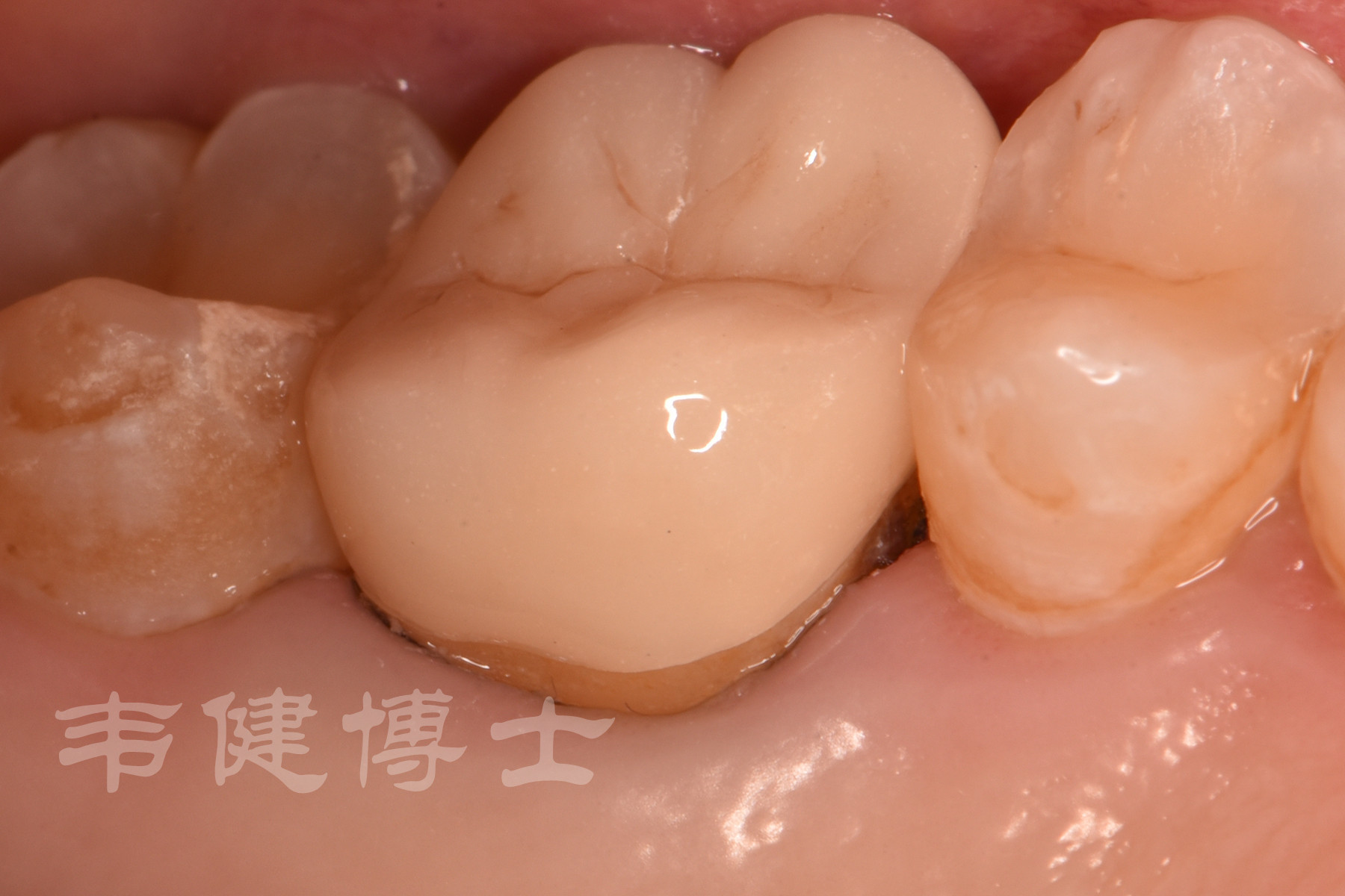 案例分享|根管治疗后第一磨牙数字化全瓷冠修复