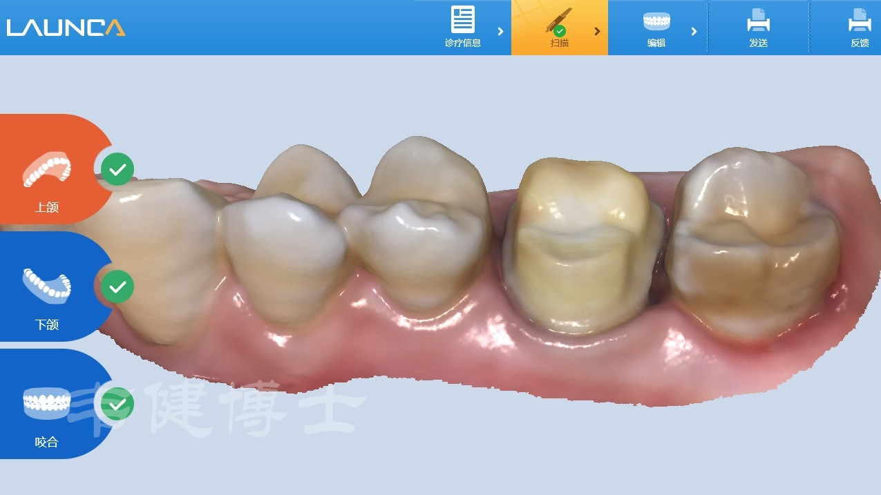 案例分享|根管治疗后第一磨牙数字化全瓷冠修复