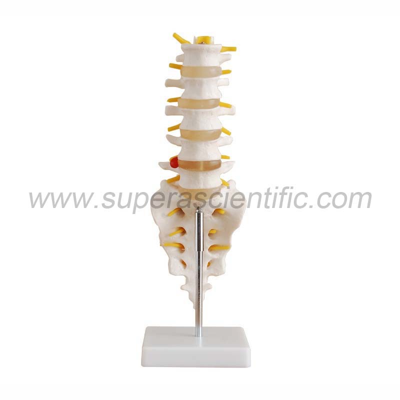 SA-119 Life-Size Lumbar Vertebrae with Sacrum & Coccyx and Herniated Disc