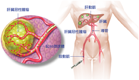 台湾钇90治疗肝癌 港安健康国际医疗