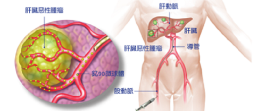 台湾钇90 肿瘤治疗 港安健康国际医疗