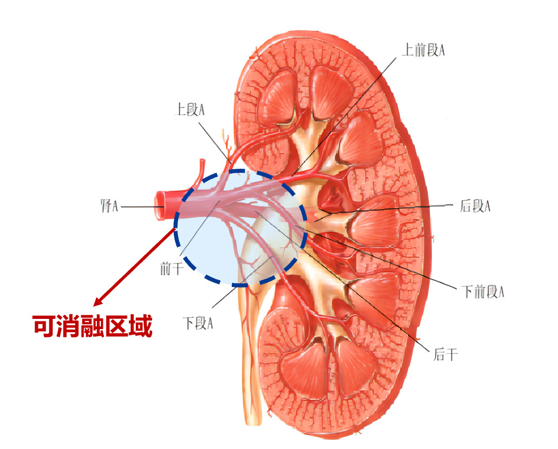 腎動(dòng)脈解剖模型