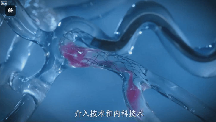 腦栓塞模型