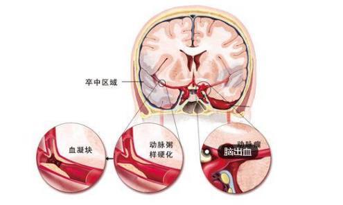 腦科專家：這些食用油不能多吃，否則得腦血栓的幾率有80%