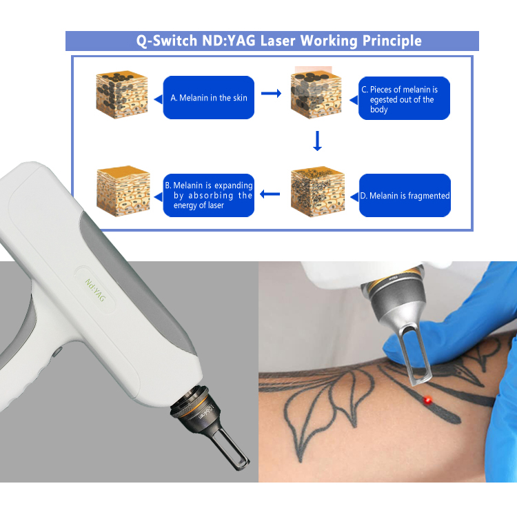 nd yag laser tattoo removal
