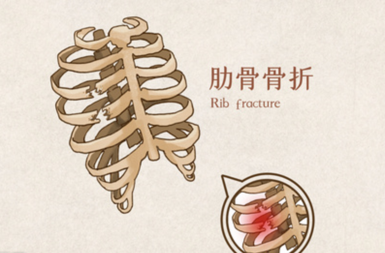 警惕老年人发生肋骨骨折