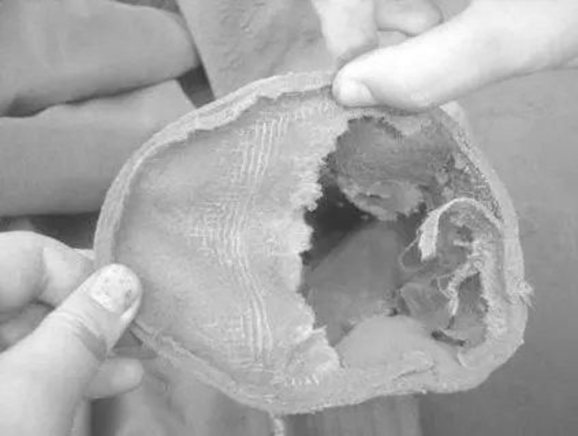 The main cause of dust collector bag damage