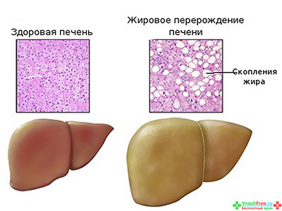 Ожирение печени