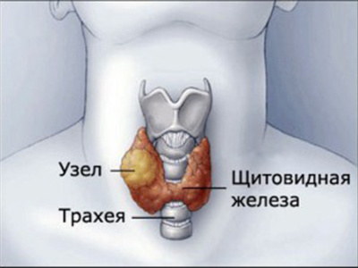 Узел щитовидной железы(меньше 2 см)