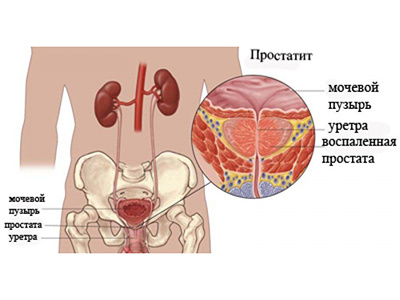 Простатит