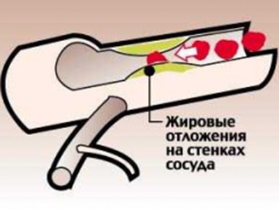 Гиперлипемия