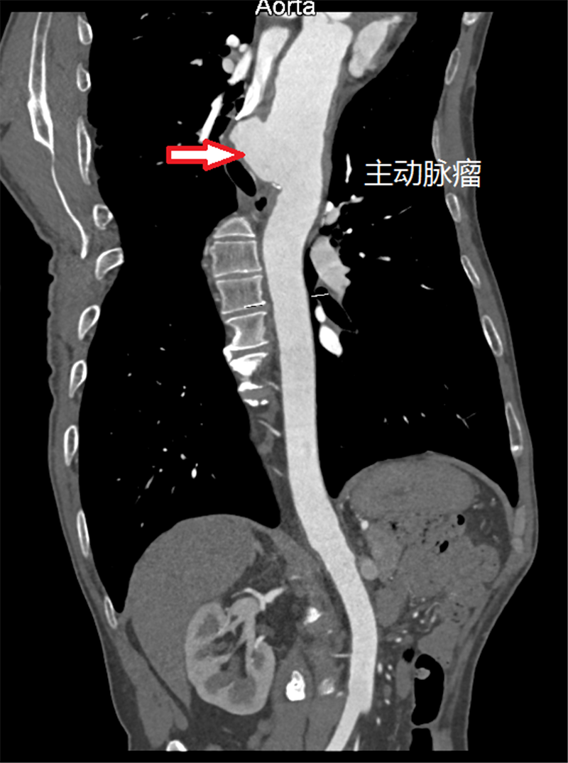 主动脉CTA图片