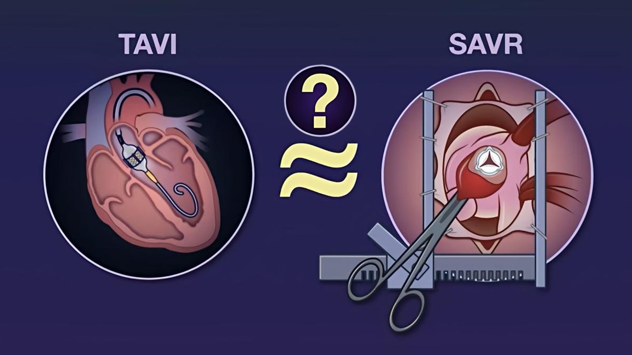 全球首个TAVR vs. SAVRȝ中高׃动脉瓣反对照研I入l接q尾?!