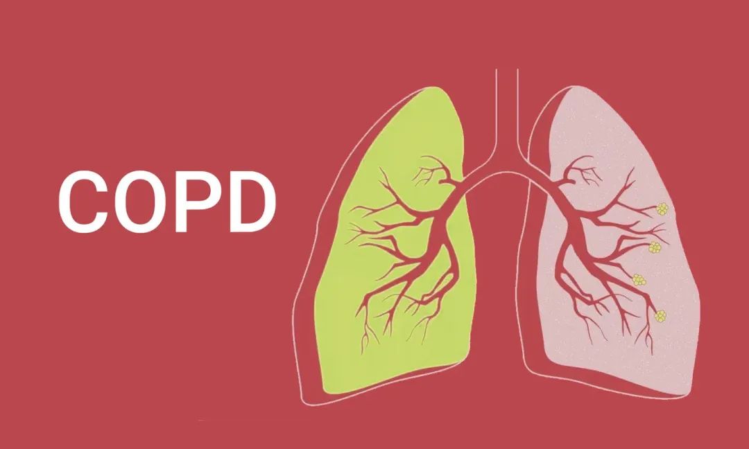 高玛安全 | 慢性阻塞性肺病宣传月 COPD Awareness Month