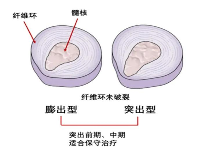 椎间盘包容