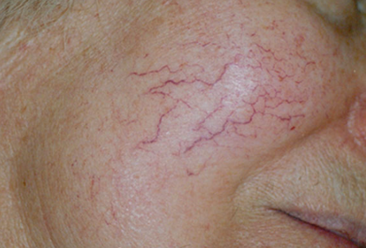What's the matter with the red vein on face?