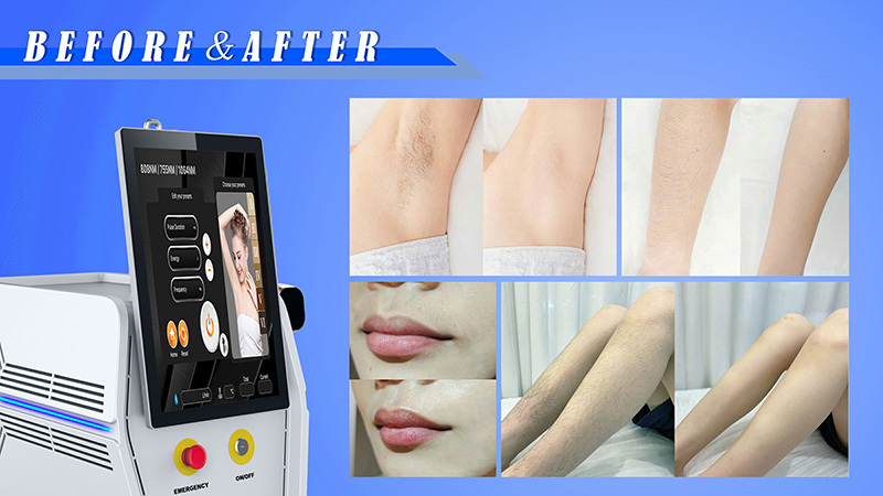 Effortless Hair Removal: The Power of 808 Diode Laser Technology