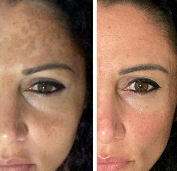 How to effectively and safely remove chloasma?
