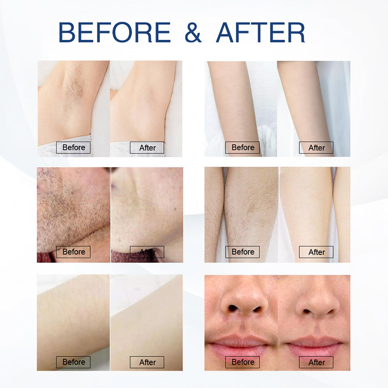The Future of Hair Removal: A Deep Dive into 808 Diode Lasers