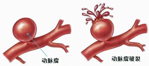 神经内科专家教您了解脑动脉瘤