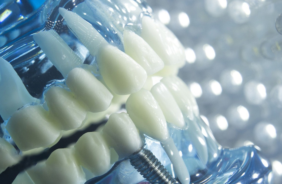 Dental lmplant Solution