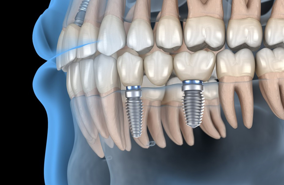 Digital Crown and Bridge Restoration