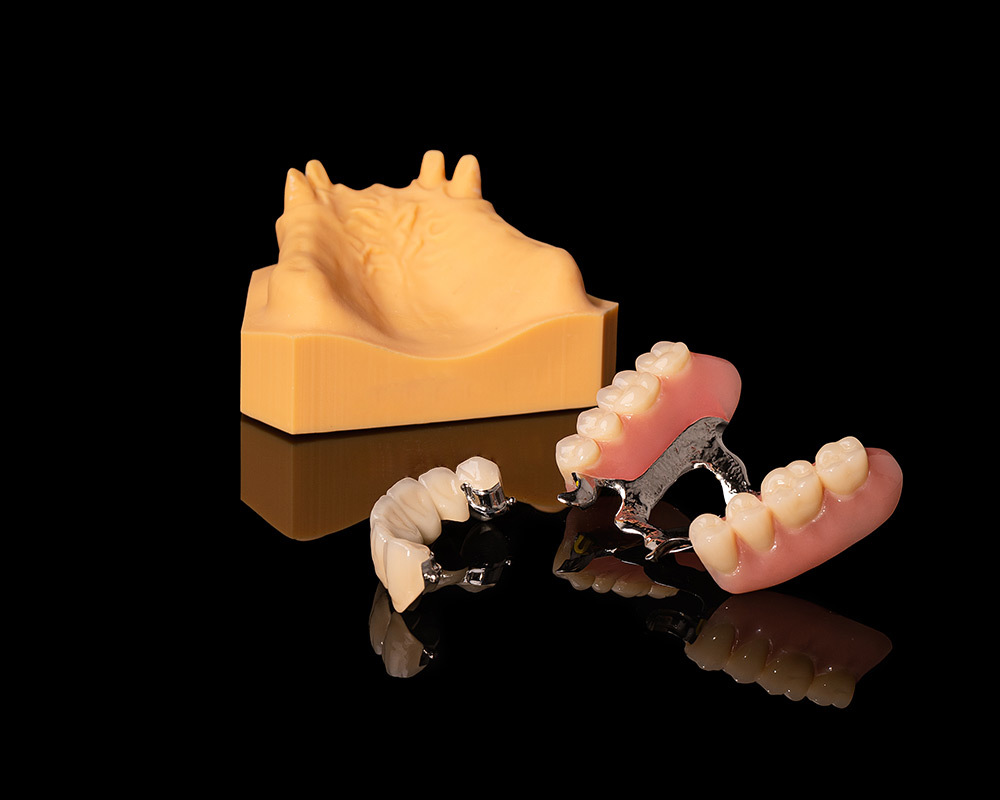 PFM Bridge and Removable Partial Combo PFM Bridge and Removable Partial Combo