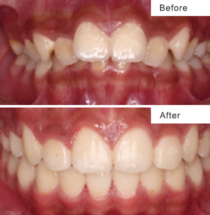 Mandibular retrusion