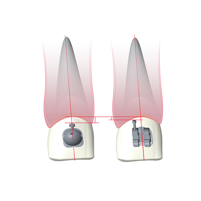 O-Brace Orthodontic Self-Ligating System