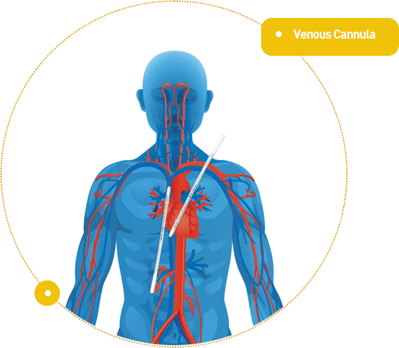 Intravenous cannula/Veneous Cannula