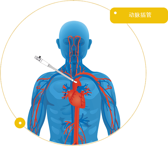 动脉插管/ Arterial Cannula 动脉插管/ Arterial Cannula