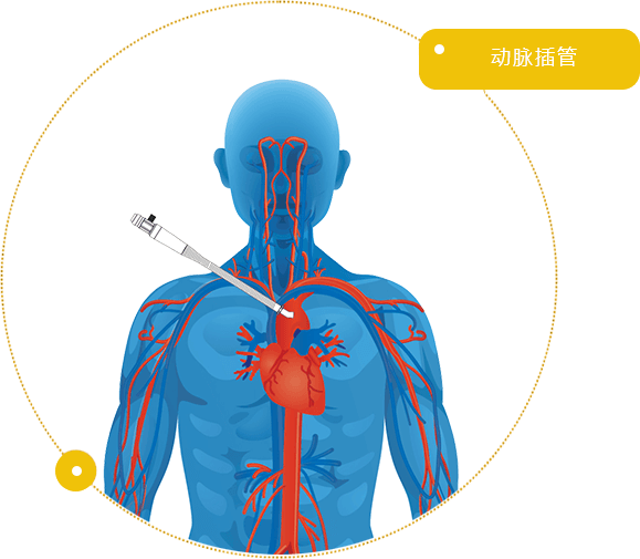 动脉插管/ Arterial Cannula