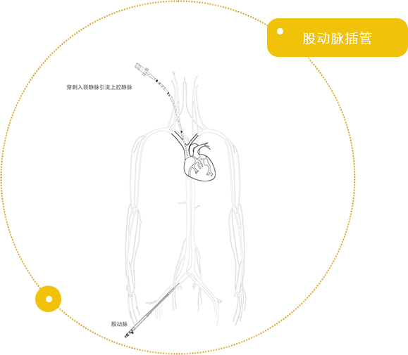 股动脉插管/ Femoral Arterial Cannula