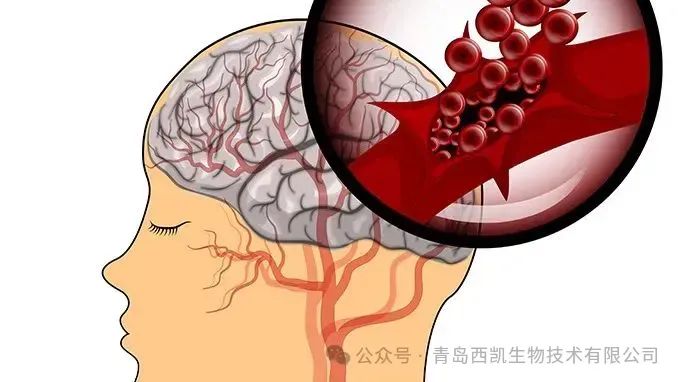 干細胞治療為高血壓腦出血的治療提供了一種全新的希望