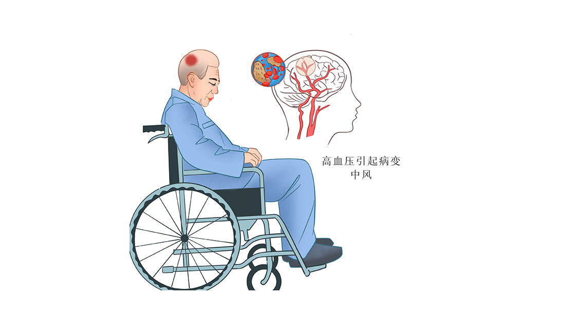 吉卡科普 | 干細胞為腦梗死患者帶來新希望